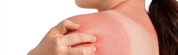 Sunburn Skin Damage and Effective Remedies